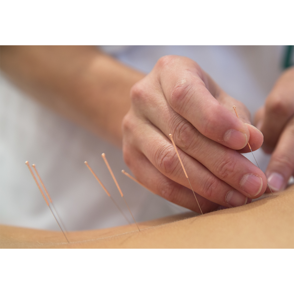 AcuTop AcuTop® Acupuncture Needle Type 5CB purchase online